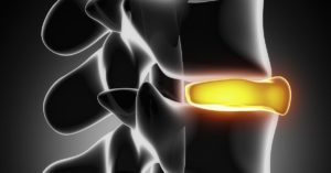Prevent Spinal Degeneration With Chiropractic Care From AICA Tucker | AICA Tucker