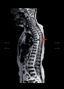What is Spinal Subluxation
