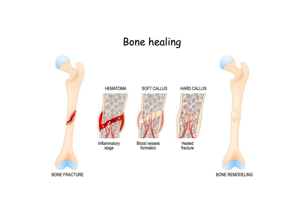 Signs That Your Broken Bone Is Healing Well