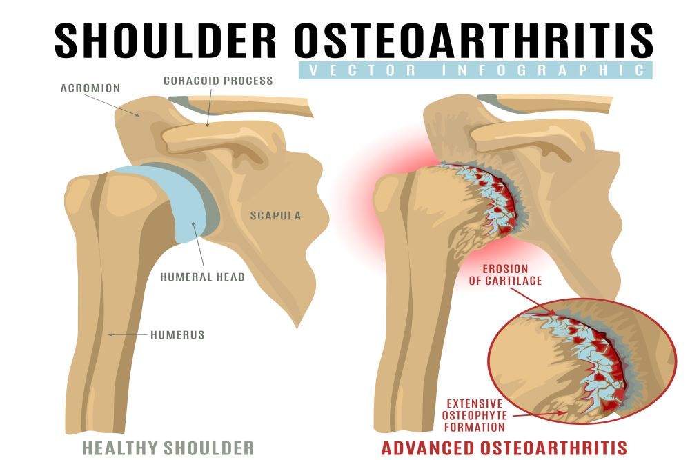 Types of Shoulder Arthritis